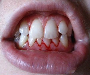 parodontez